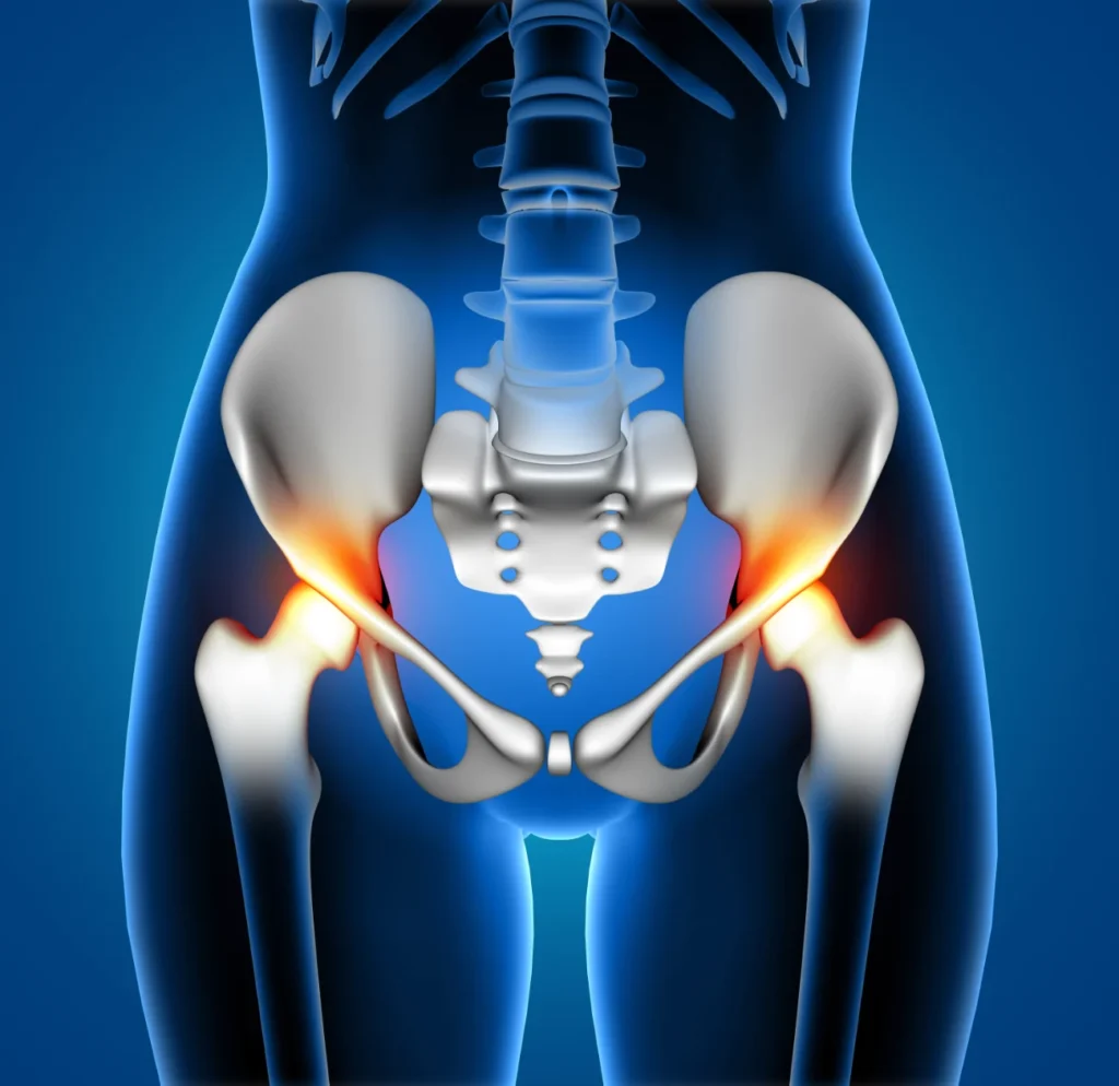 piriformis syndrome compressing sciatic nerve causing leg pain